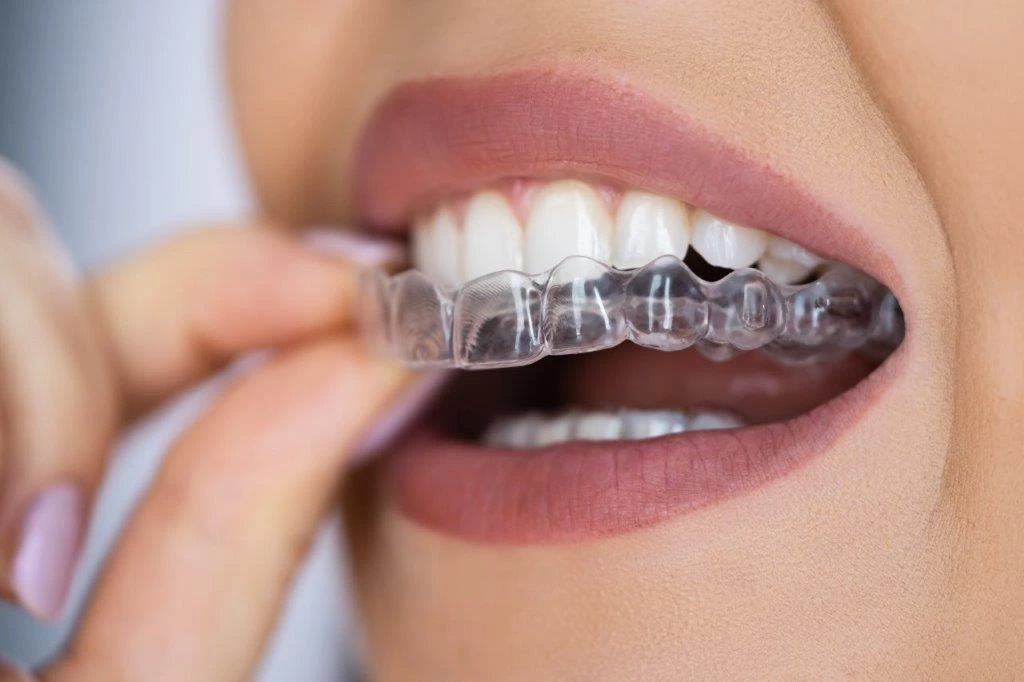Invisalign Tigard Or