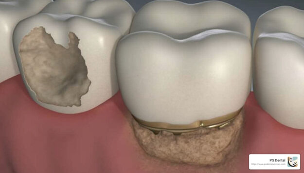 hole in molars