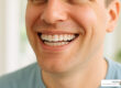 Affordable clear aligners