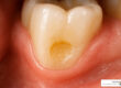 class 5 cavity - best restorative material for class 5 cavity