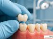 Tigard dental crowns