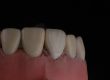 cavity restoration