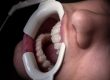 gum disease treatment