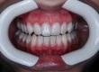 teeth straightening