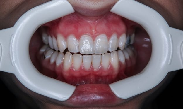 teeth straightening