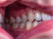 what is periodontal disease