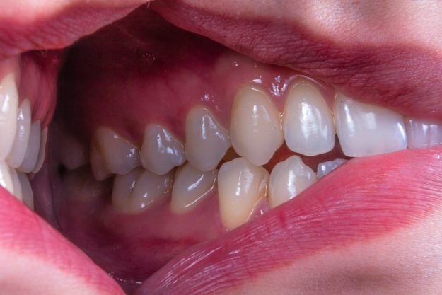 what is periodontal disease