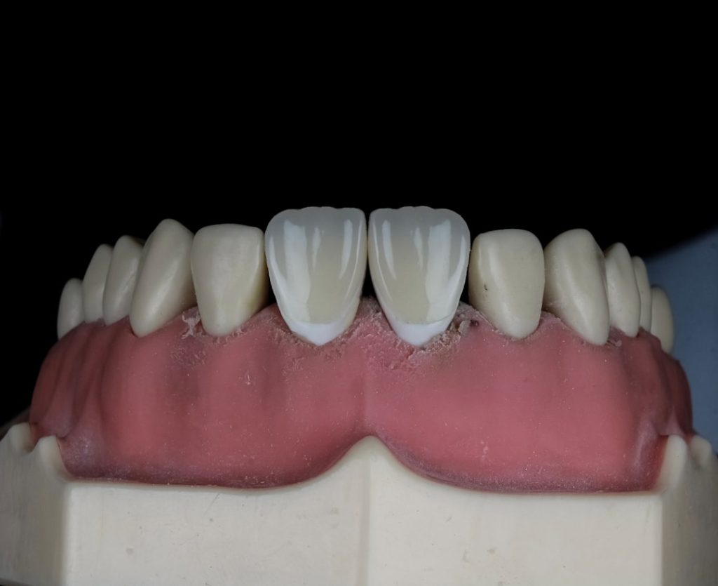 tooth decay below gum line treatment